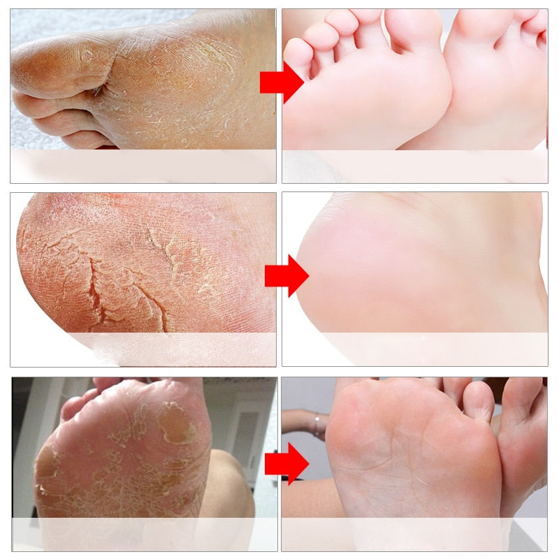 Feet Mask Remove Dead Skin - EvoltOne